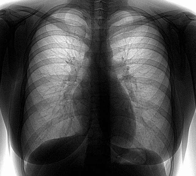 Флюорография - снимок